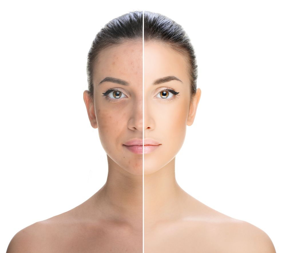 Simulation of skin before and after IPL™ Therapy
