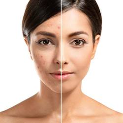 Photo of a woman before and after acne scar removal