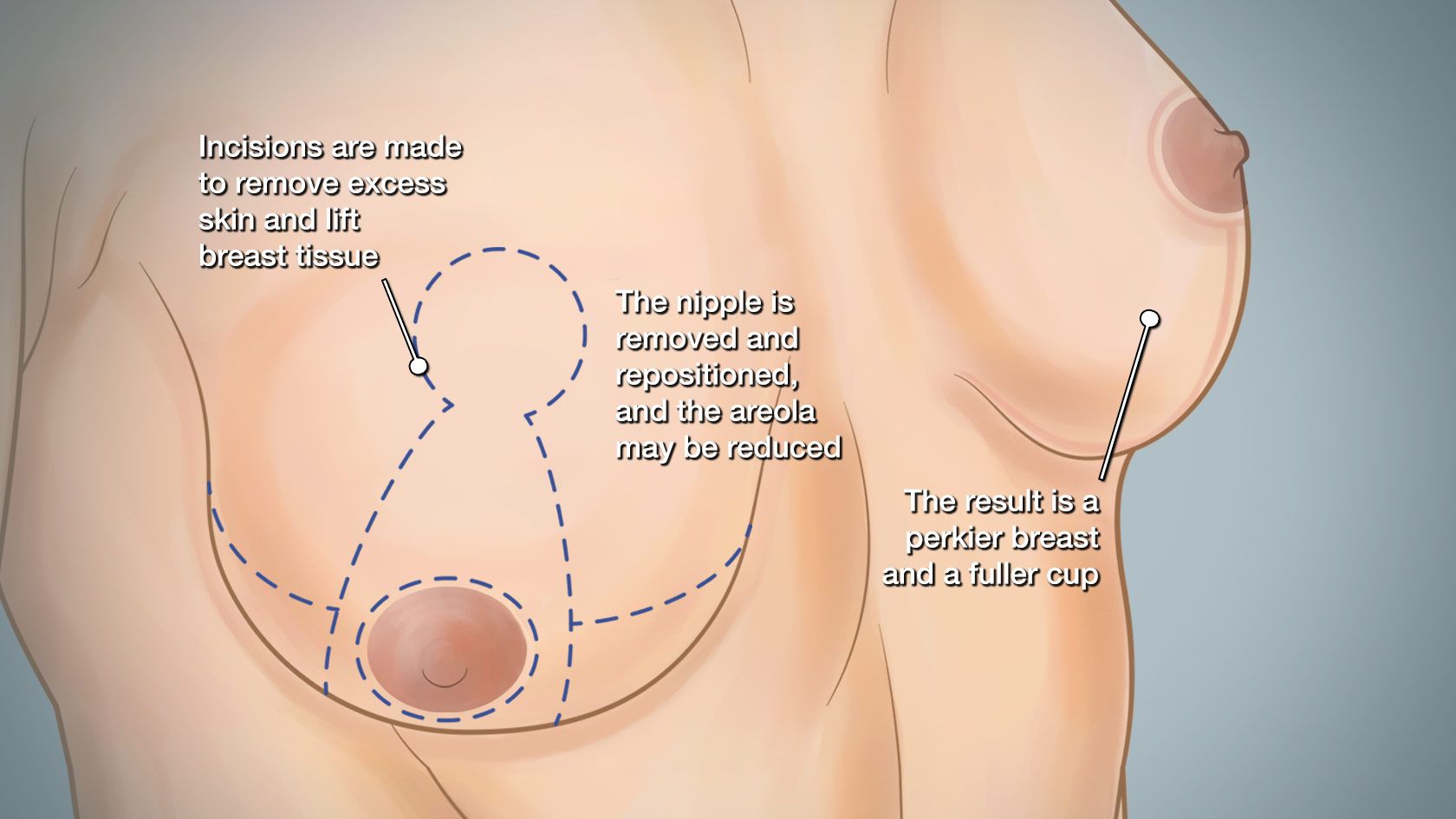 Illustration stating: Incisions are marked to remove excess skin and lift breast tissue. The nipple is removed and repositioned, and the areola may be reduced. The result is a perkier breast and a fuller cup.