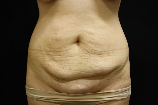 sagging skin and excess fat before the tummy tuck