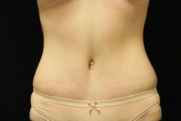 a smooth slender tummy after the procedure